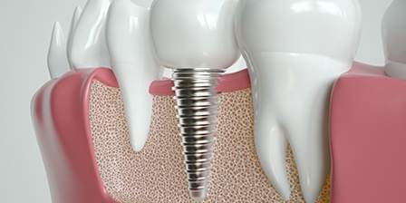 Render of dental implant in Oklahoma City, OK in jaw
