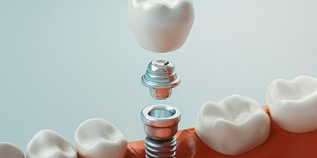 Illustration of crown, abutment and dental implant in Oklahoma City, OK
