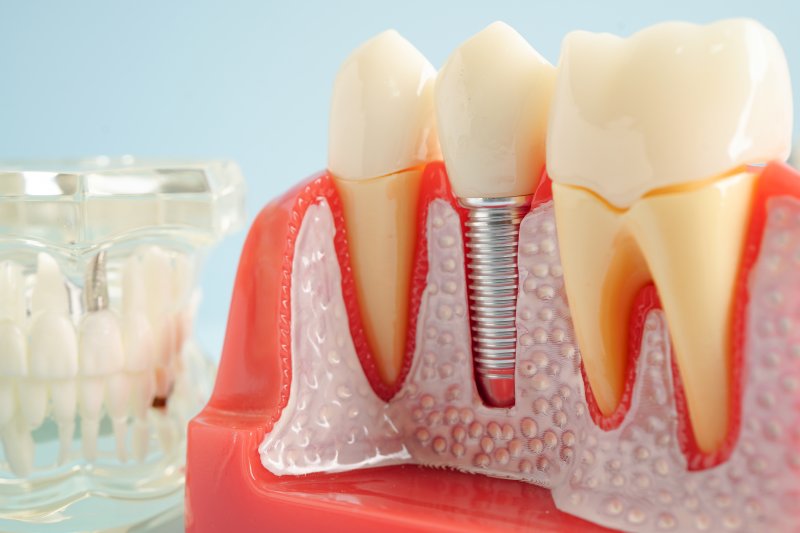 a model of a dental implant in the jawbone